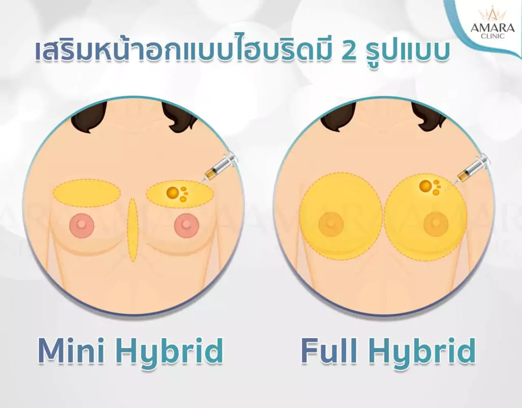 ทำนม เสริมหน้าอก