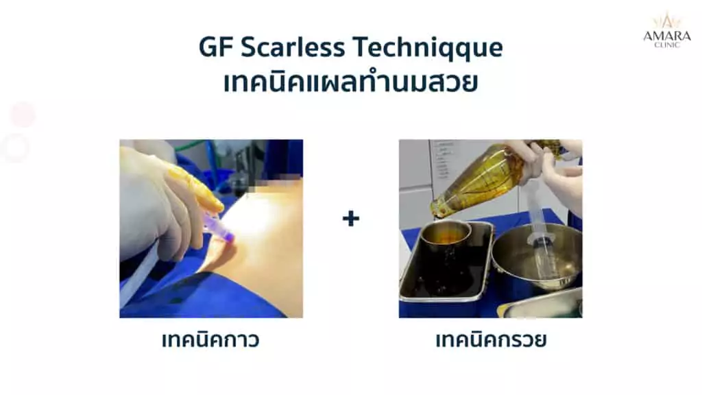 ทำนม เสริมหน้าอก