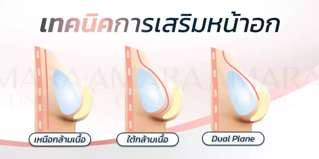 ทำนม เสริมหน้าอก